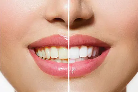 Tandblegning giver hvide tænder og smukke smil!