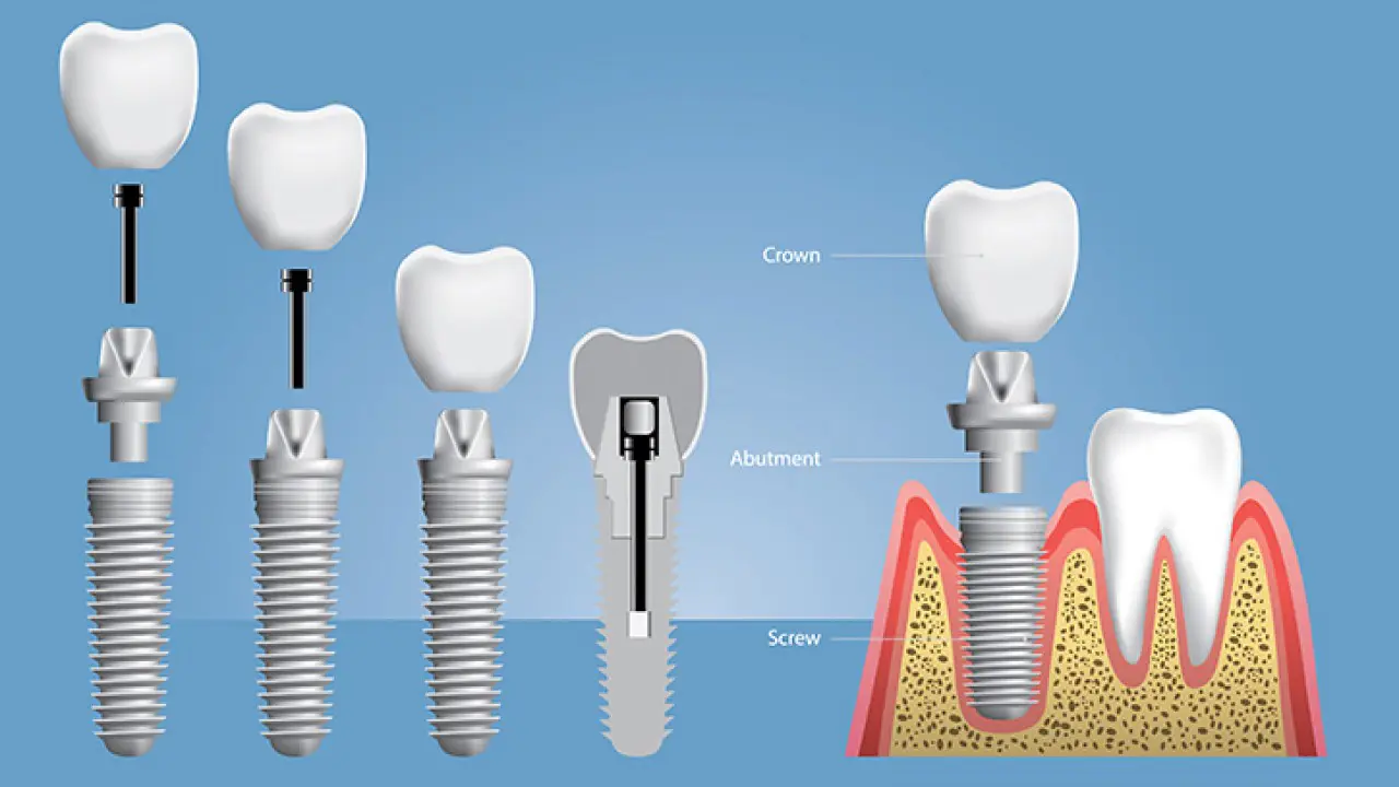 Procedure ved implantater