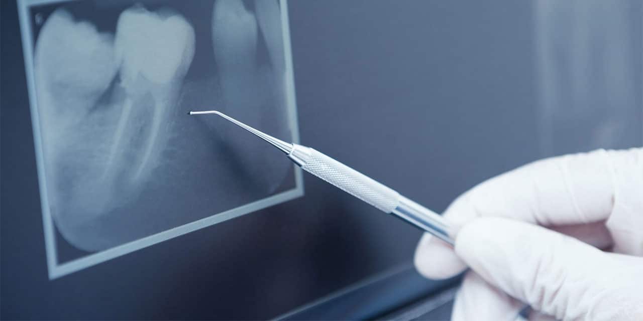 Rodbehandling Betændelse i tandens rod Dentalklinikken