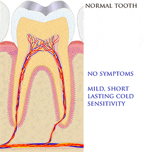 Symptomer på tandpine (Pulpitis)