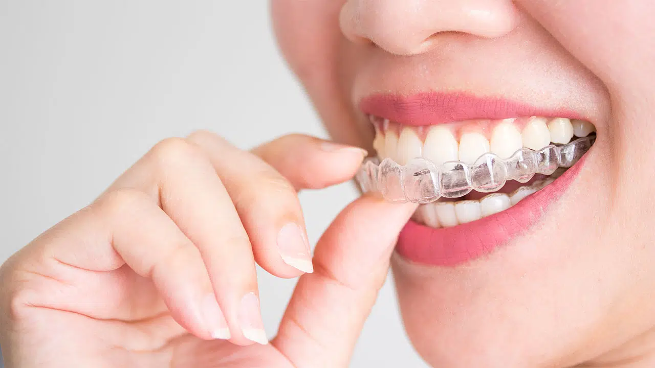 Usynlig tandregulering med Invisalign