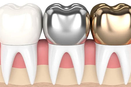 Dental Crowns