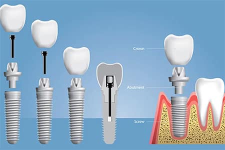 Dental Implants