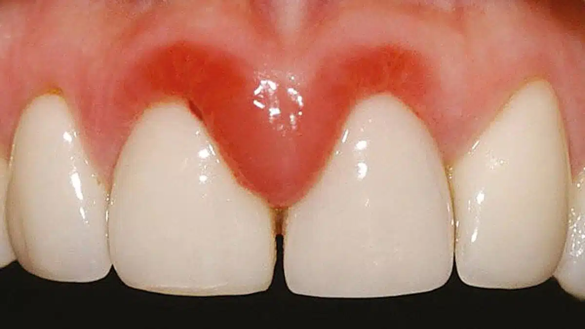 Betændt tandkød med rødme og hævelse